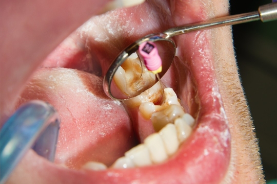 leczenie kanałowe zęba mężczyzny